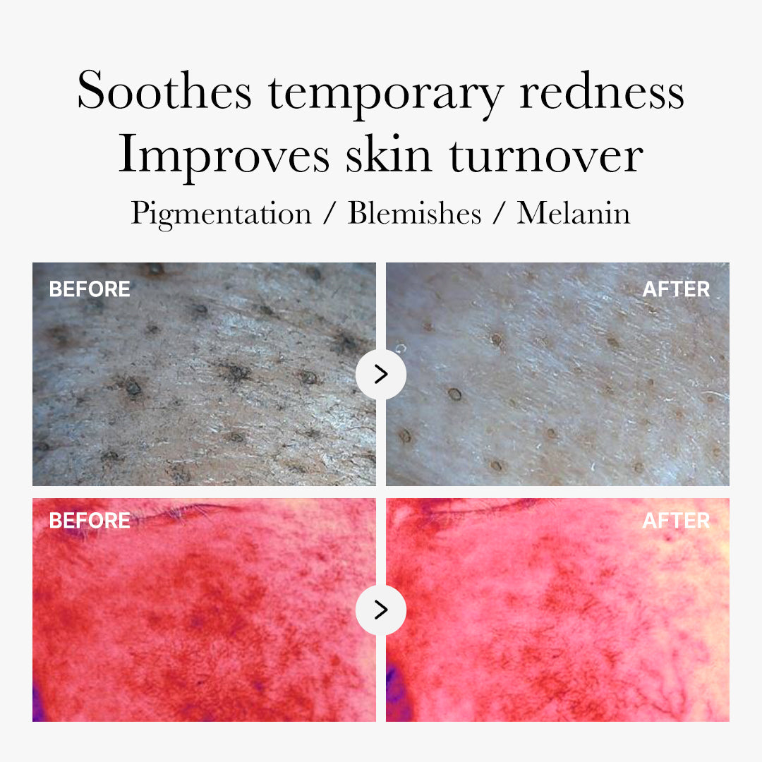 Red Succinic Acid Panthenol Pads - Exfoliating Toner Pads for Breakout-Prone Skin