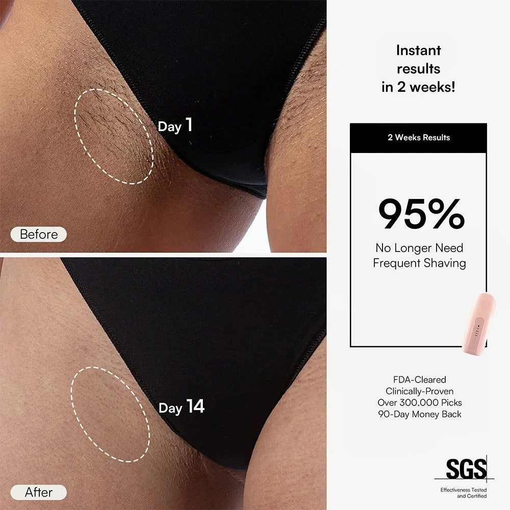 FOND IPL Hair Removal Device – Long-Lasting At-Home Treatment