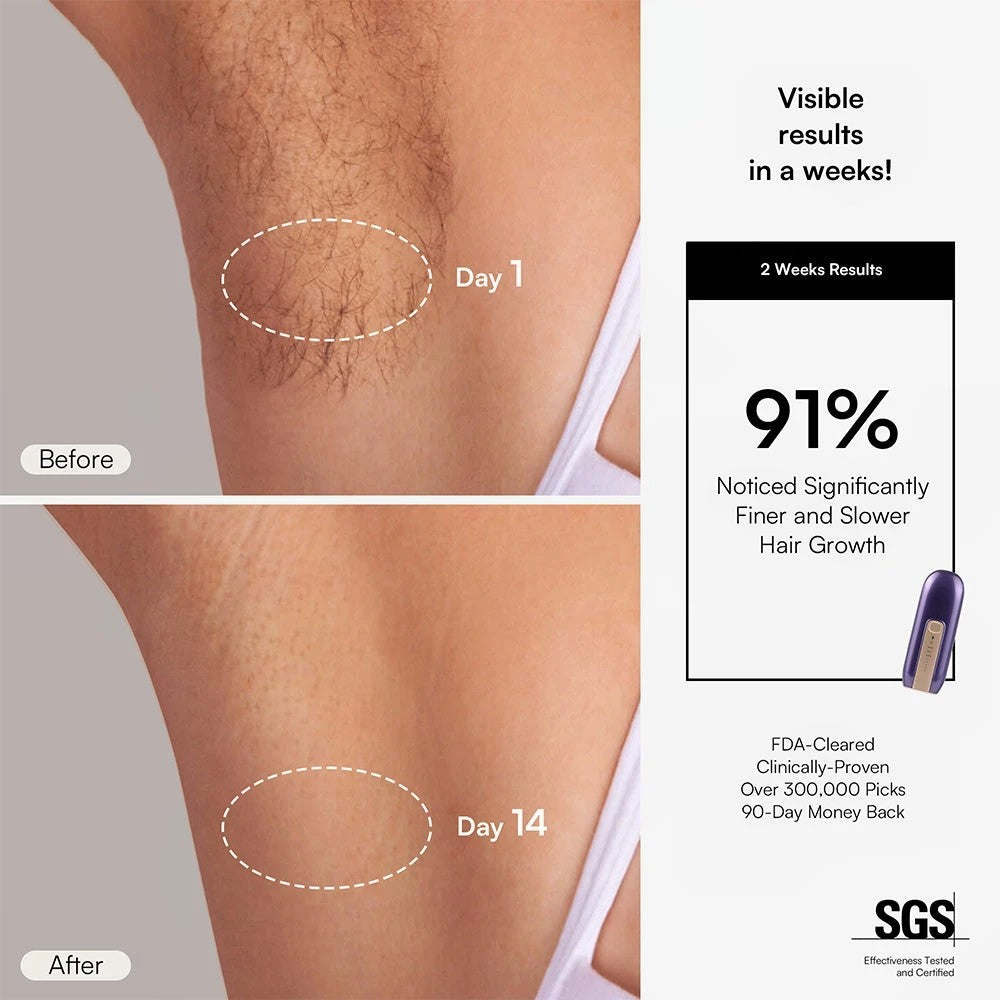 FOND IPL Hair Removal Device – Long-Lasting At-Home Treatment
