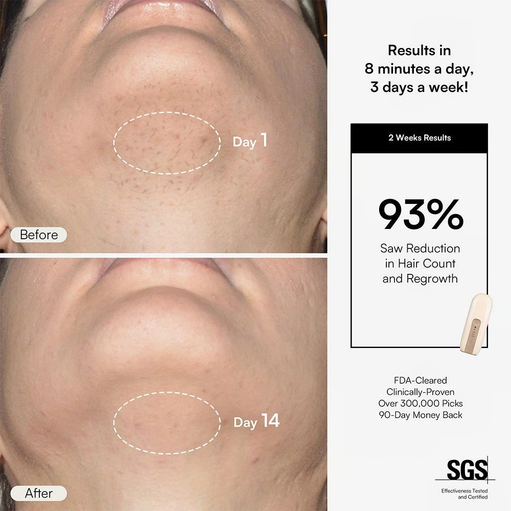 FOND IPL Hair Removal Device – Long-Lasting At-Home Treatment