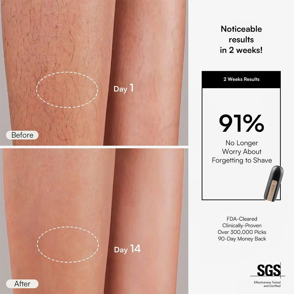 FOND IPL Hair Removal Device – Long-Lasting At-Home Treatment