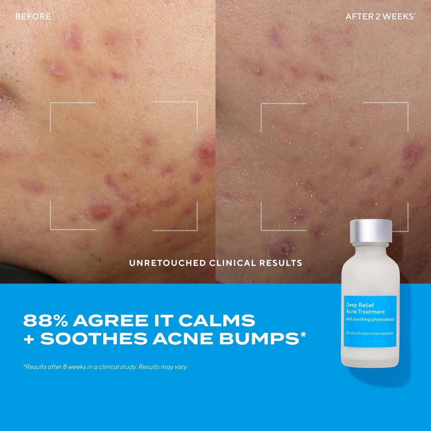 Deep Relief Acne Treatment – Clarifying Facial Formula, 1 oz