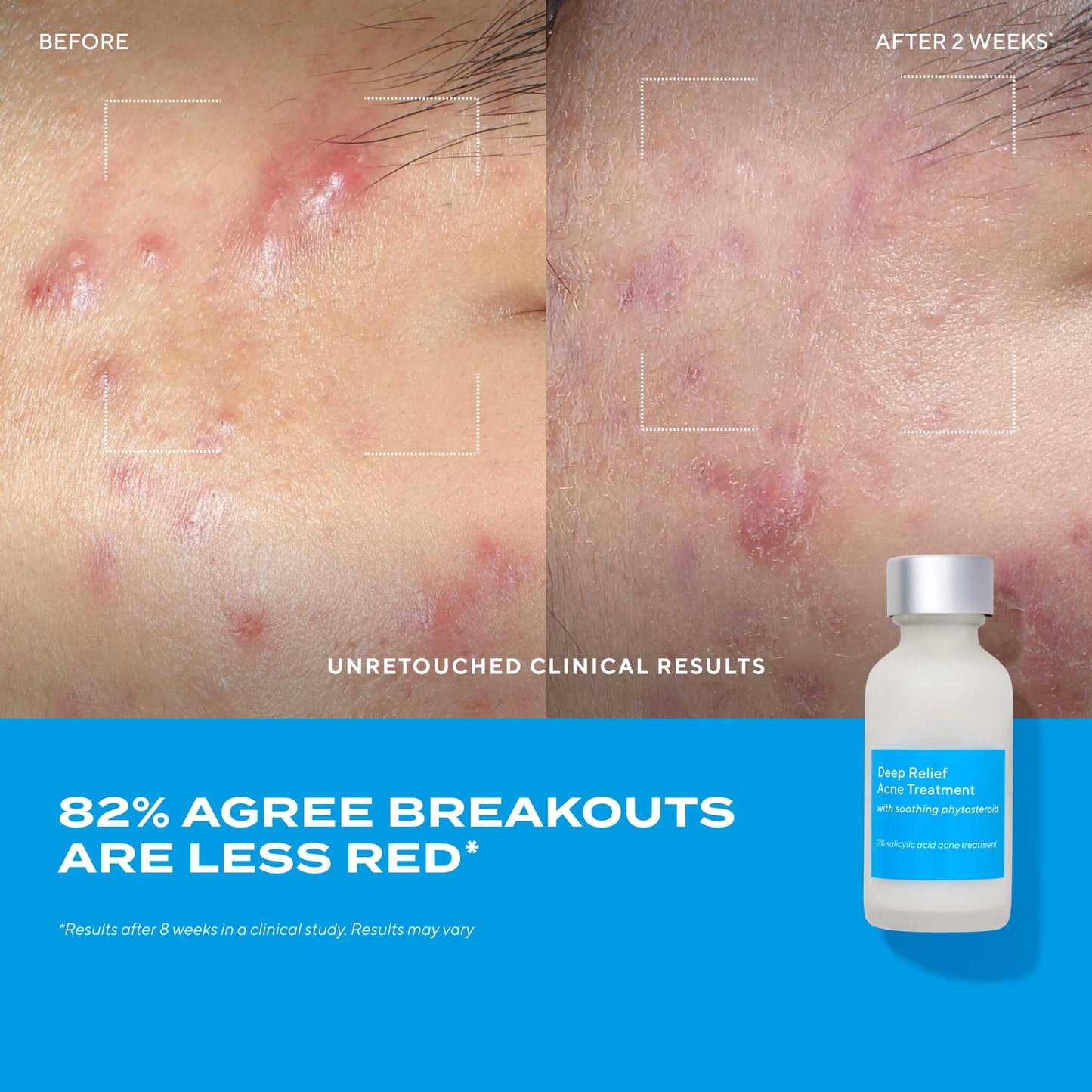 Deep Relief Acne Treatment – Clarifying Facial Formula, 1 oz