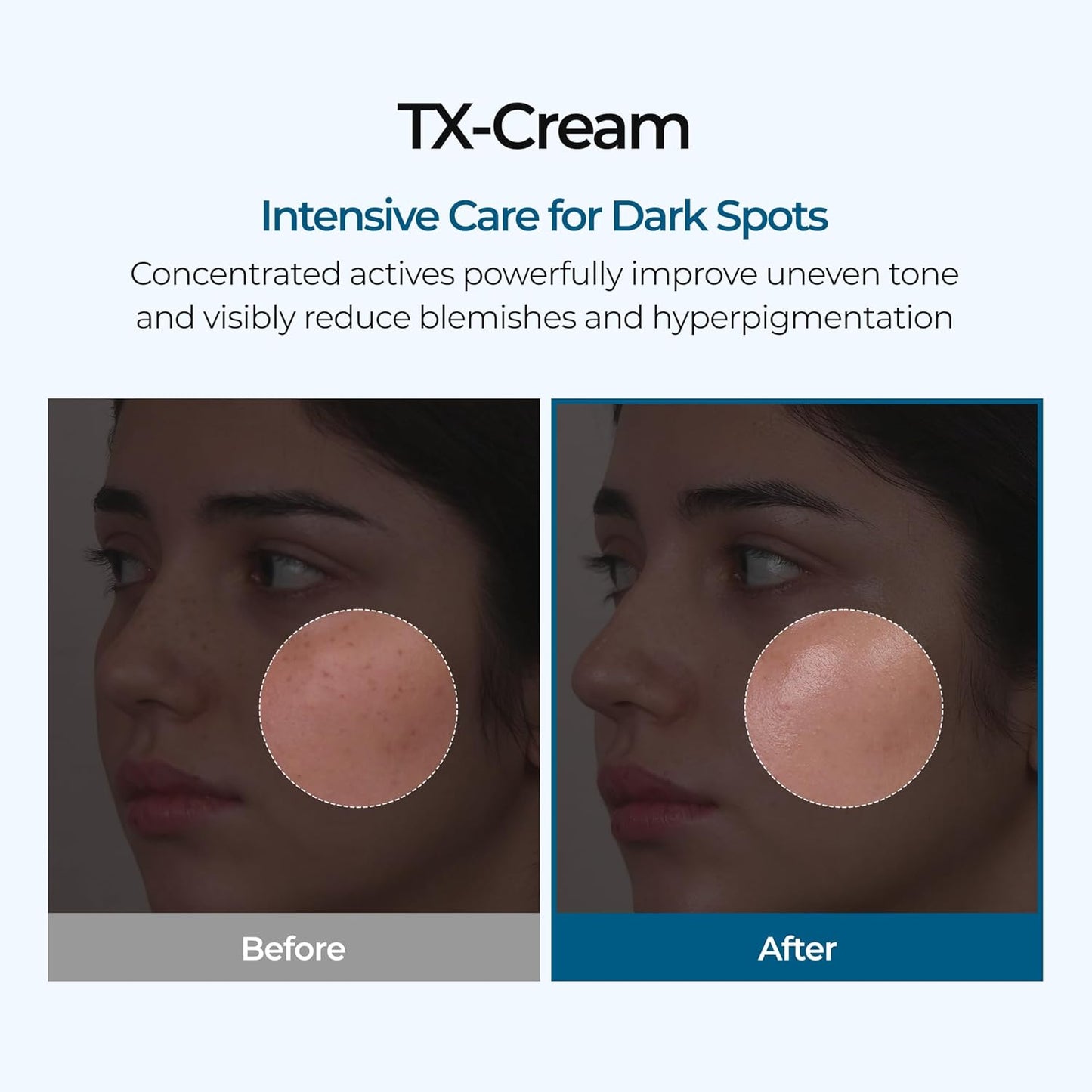 TX Tranexamic Acid Cream – Dark Spot & Tone Care, 50ml
