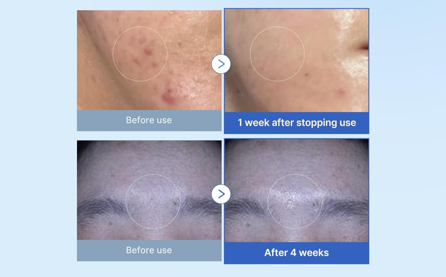 Zero Exosome Shot 25,000 PPM Spicule Serum – Skin Booster