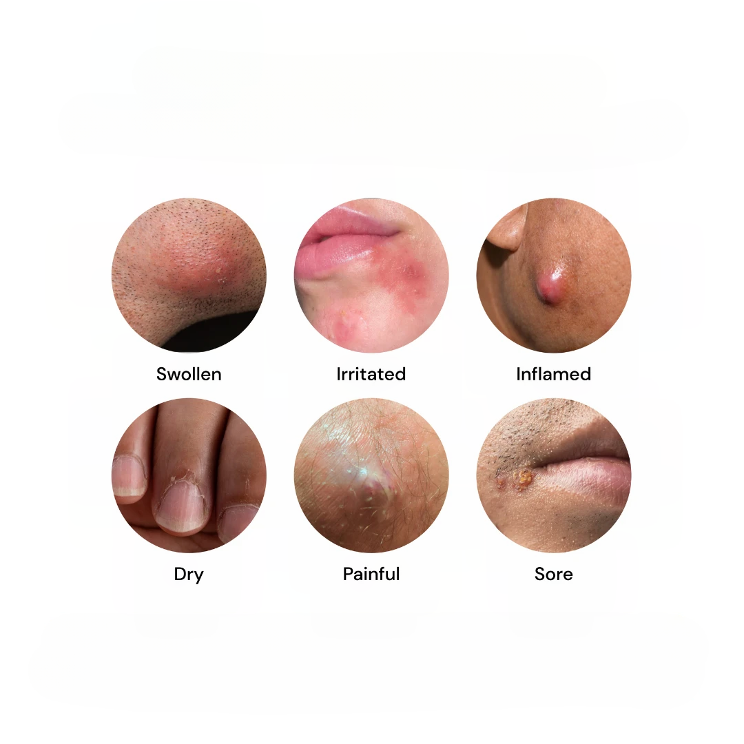 Close-up skin conditions showing swollen, irritated, inflamed, dry, painful, and sore areas commonly treated with Universal Flare Care
