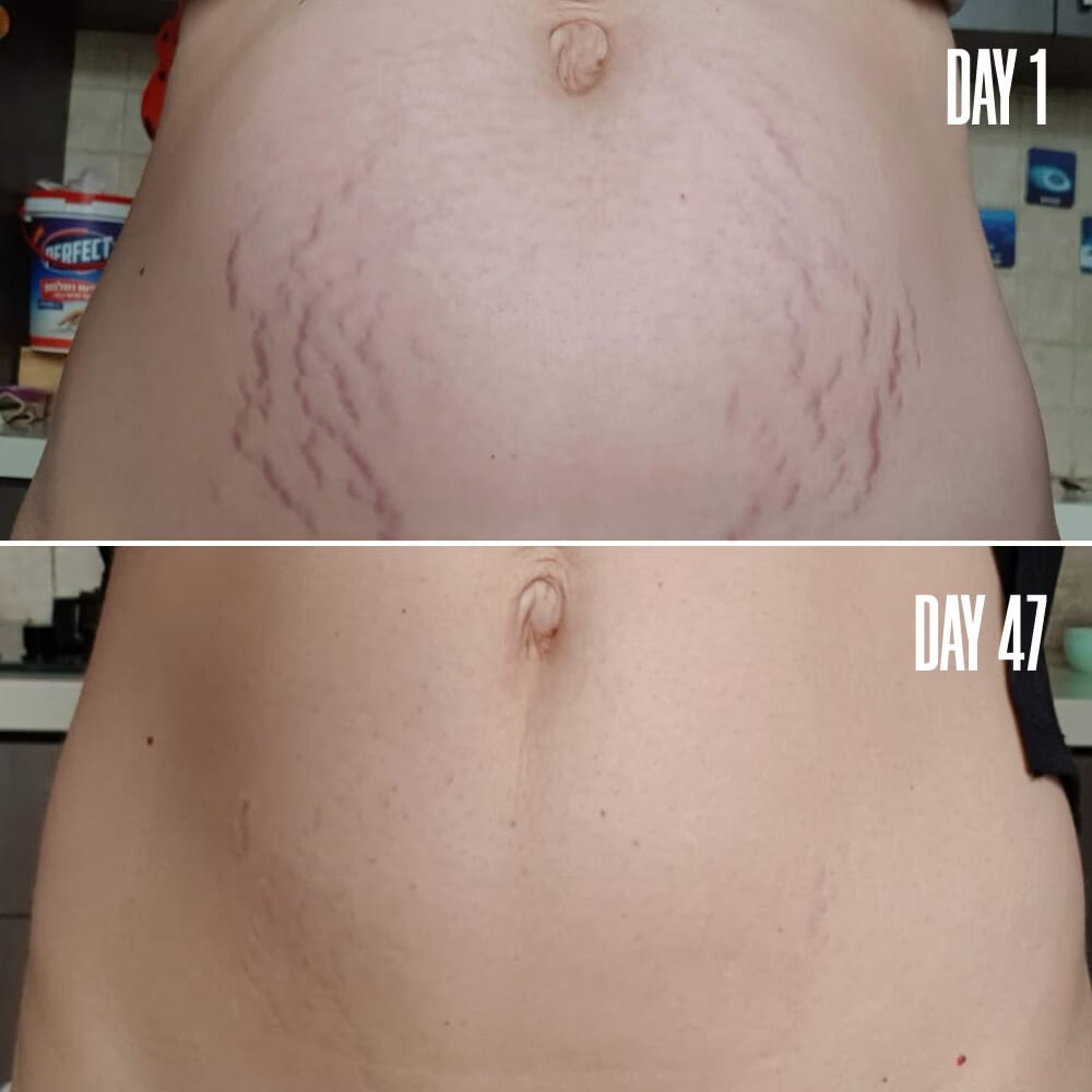 Sleek ‘N’ Chic The Arm & Belly Duo - The Stretch Mark & Saggy Skin Solution for a Smoother, Firmer Look