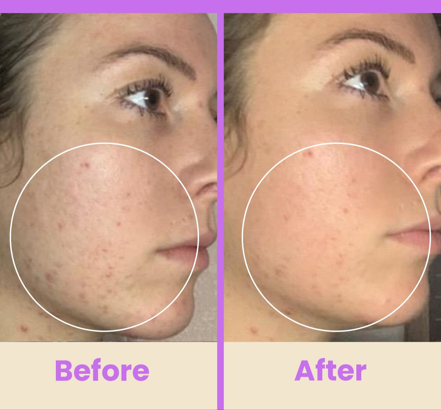 NuDerma Professional High Frequency Wand – Facial Skincare Tool