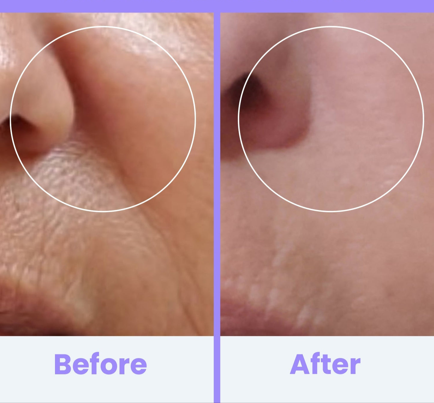 NuDerma Clinical High Frequency Wand – Facial Skincare Tool