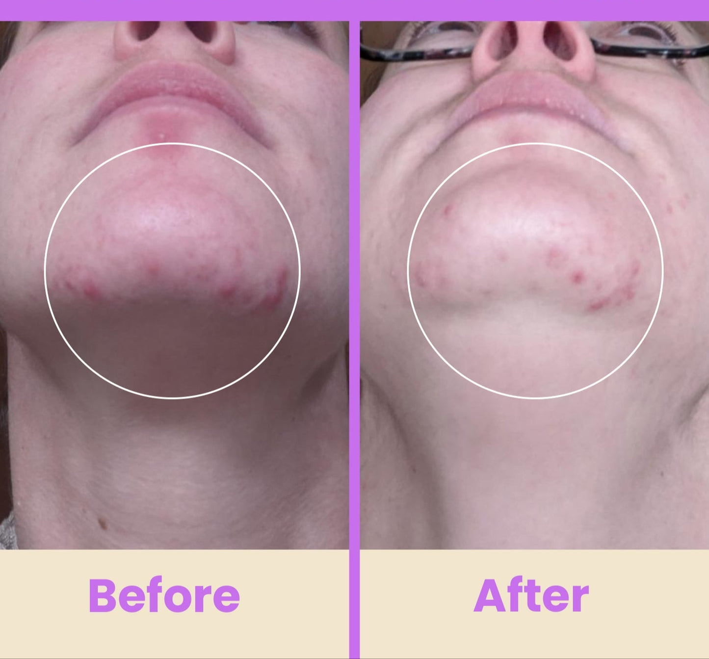 NuDerma Professional High Frequency Wand – Facial Skincare Tool