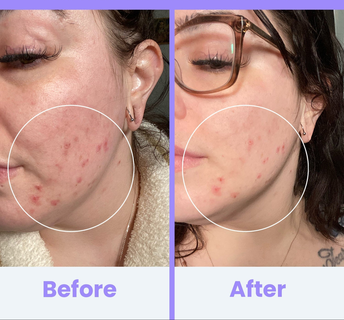 NuDerma Clinical High Frequency Wand – Facial Skincare Tool