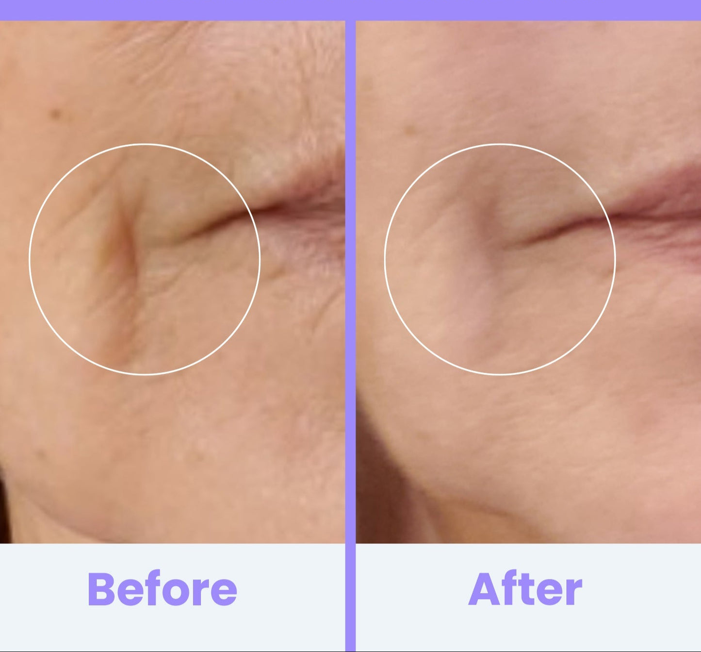 NuDerma Clinical High Frequency Wand – Facial Skincare Tool