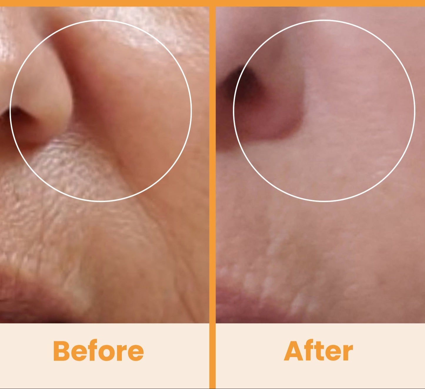 NuDerma Standard High Frequency Wand – Facial Skincare Tool