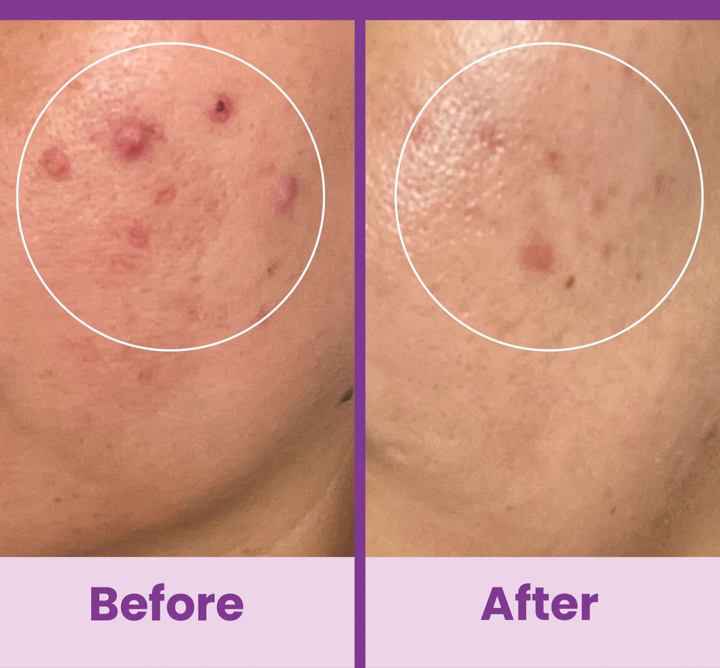 NuDerma Standard High Frequency Wand – Facial Skincare Tool