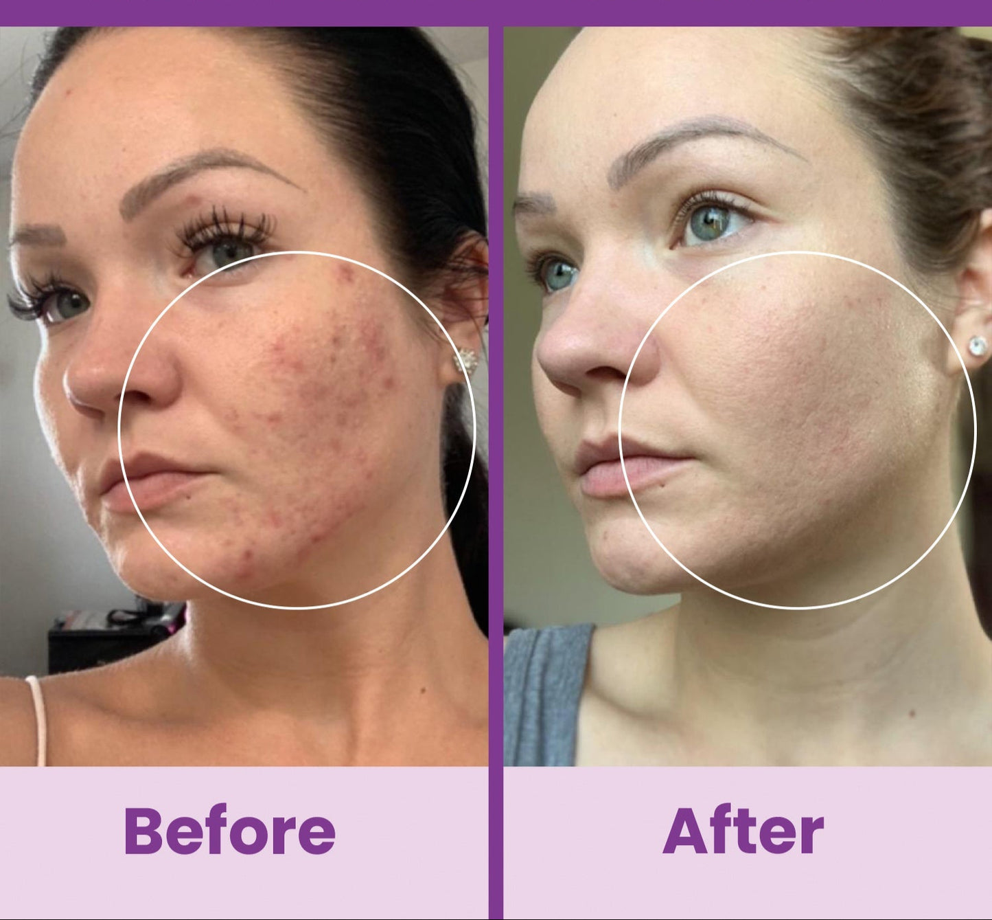NuDerma Standard High Frequency Wand – Facial Skincare Tool