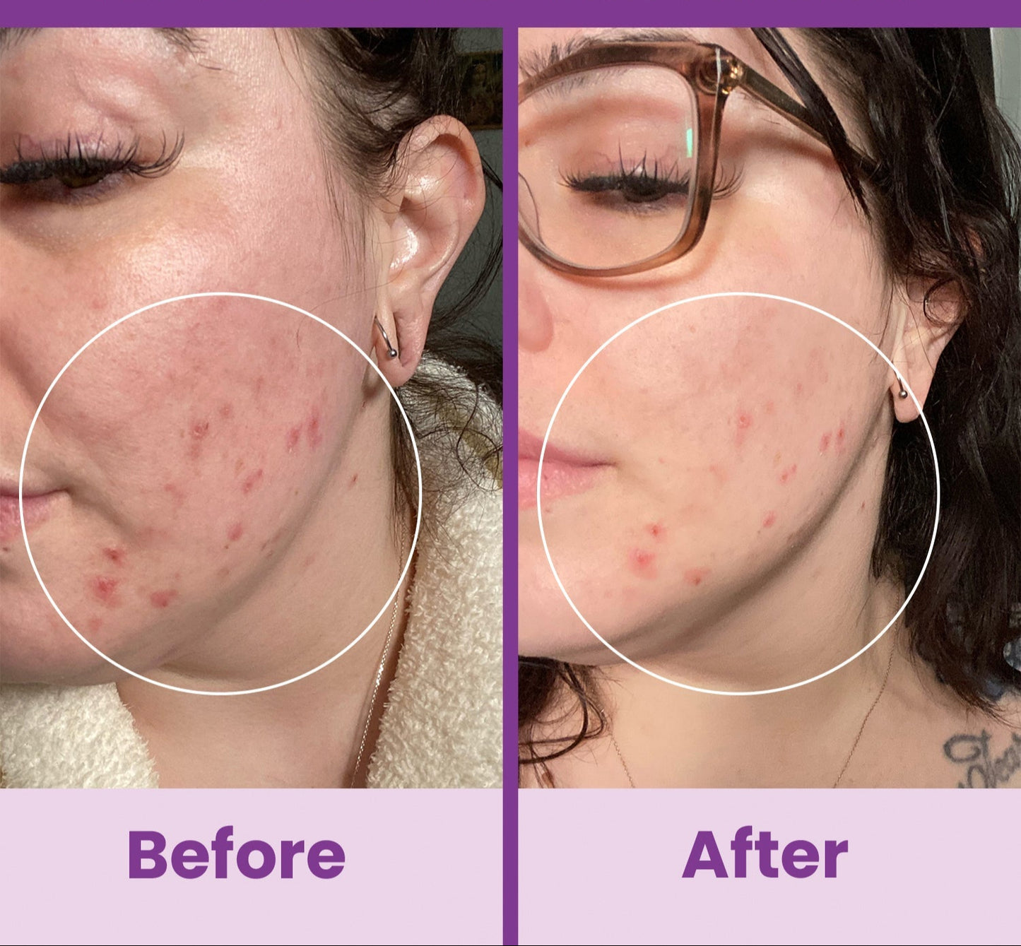 NuDerma Standard High Frequency Wand – Facial Skincare Tool