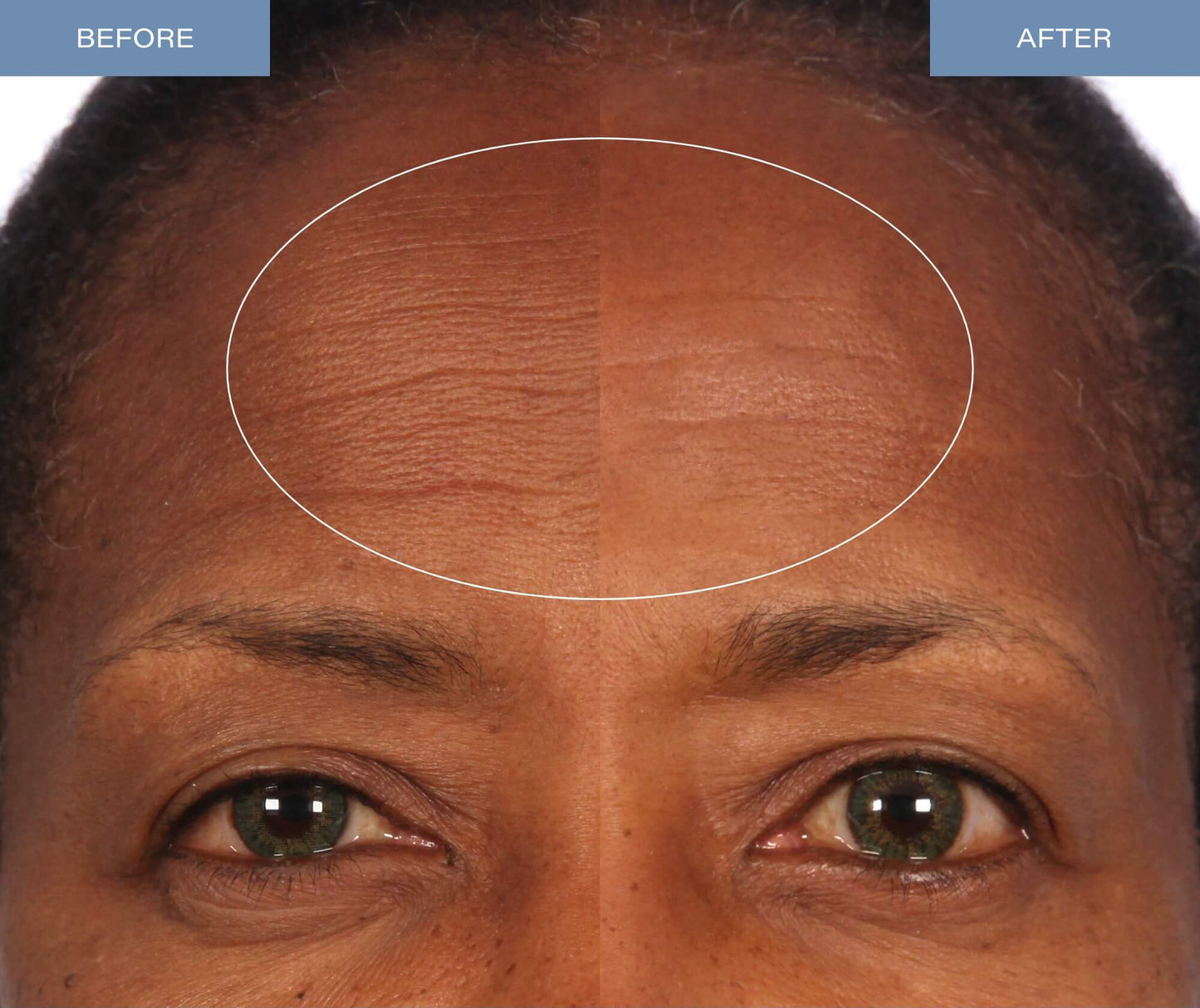Microdermabrasion Treatment - V5 Crystal Facial Exfoliant Tube