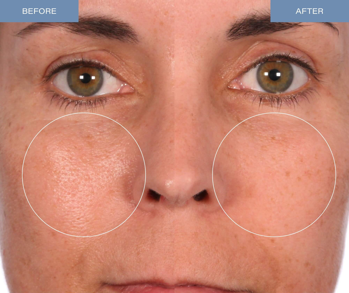 Microdermabrasion Treatment - V5 Crystal Facial Exfoliant Tube