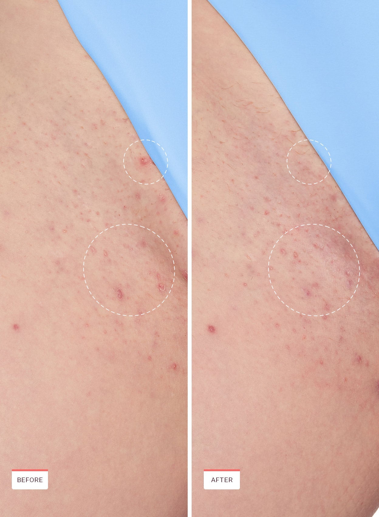 Smoothing Solution – Ingrown Hair Serum for Bumps & Razor Burn