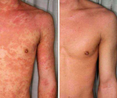 Healed My Eczema - Soothing Cream for Calming & Restoring Irritated Skin