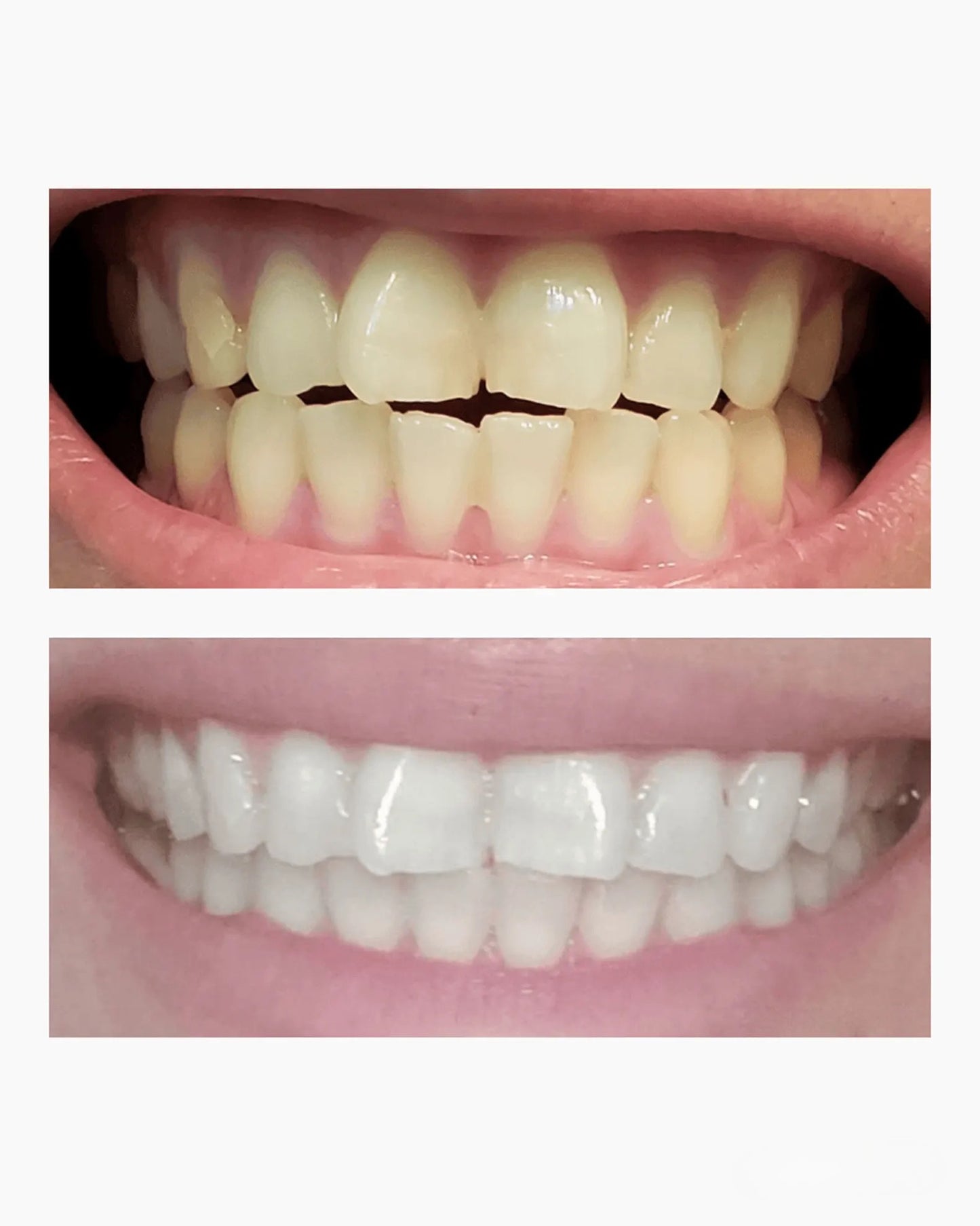 Dissolving Teeth Whitening Strips with Hydroxyapatite - Easy, Enamel-Safe Whitening Solution