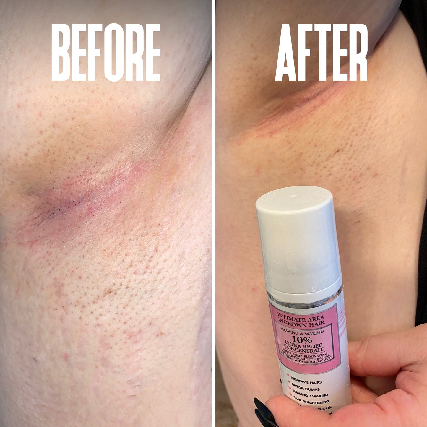 Ingrown Hair & Razor Bump Stopper – Soothes & Prevents Irritation
