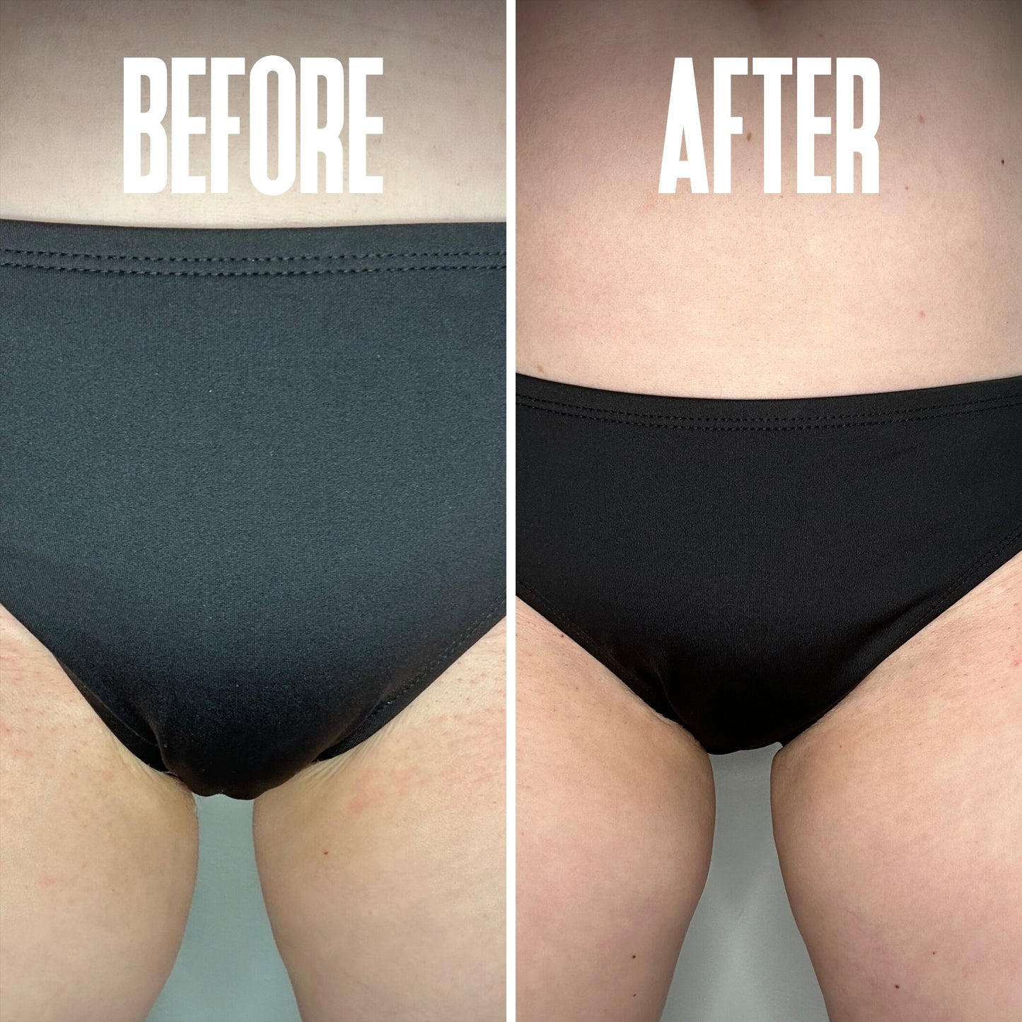 Ingrown Hair & Razor Bump Stopper – Soothes & Prevents Irritation