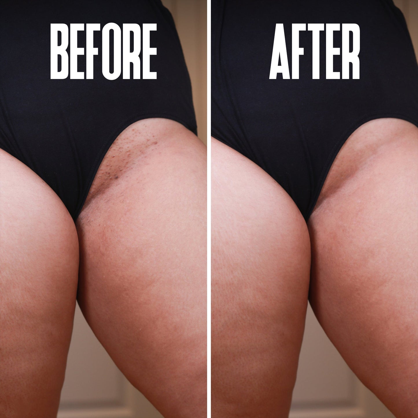 Ingrown Hair & Razor Bump Stopper – Soothes & Prevents Irritation