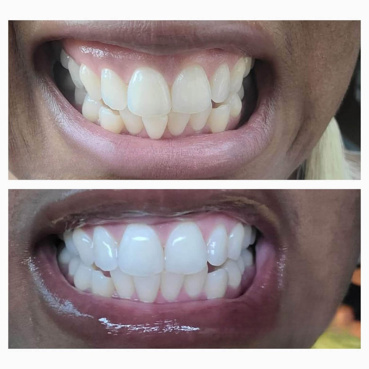 Dissolving Teeth Whitening Strips with Hydroxyapatite - Easy, Enamel-Safe Whitening Solution