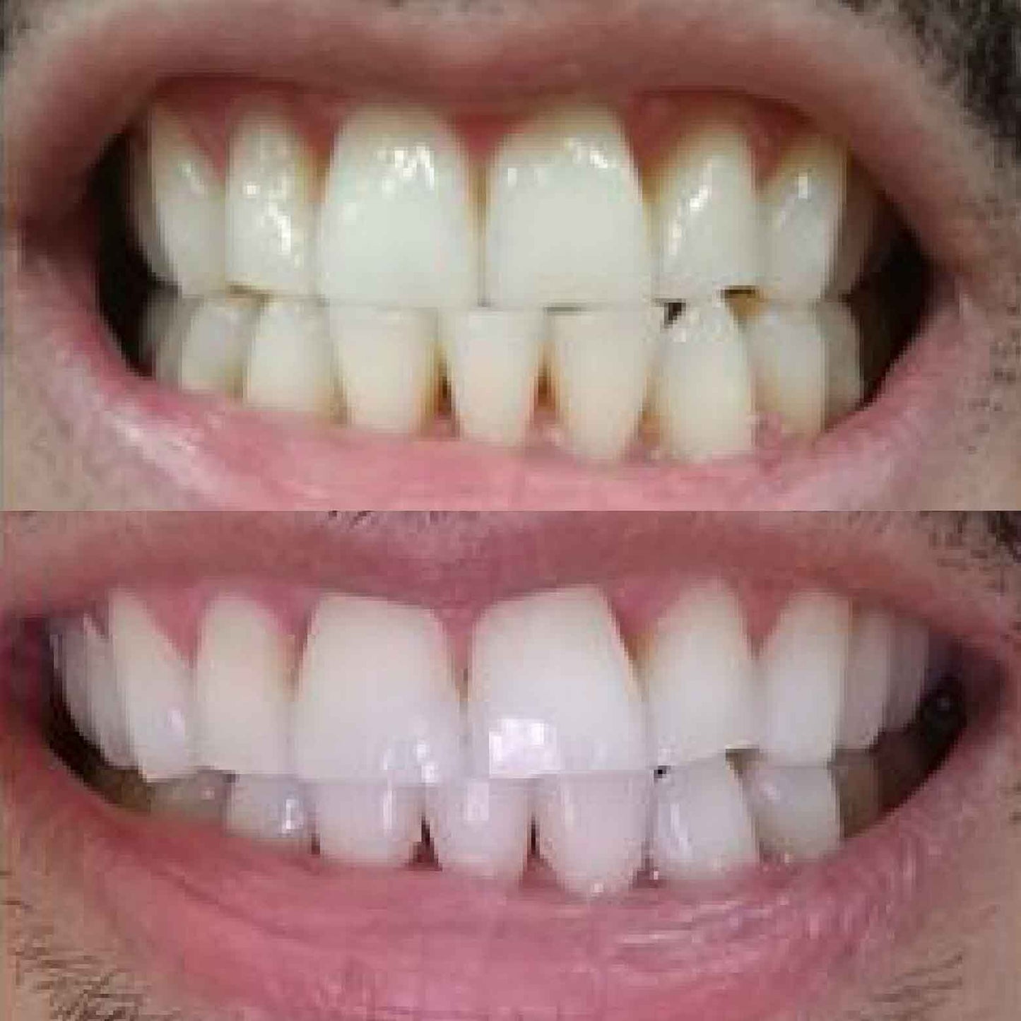 Nano-Hydroxyapatite Toothpaste – Whitens, Strengthens & Protects Teeth