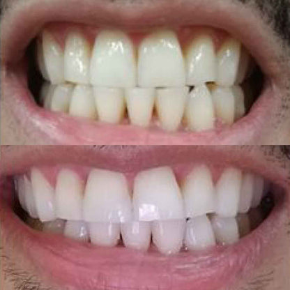 Nano-Hydroxyapatite Toothpaste – Whitens, Strengthens & Protects Teeth