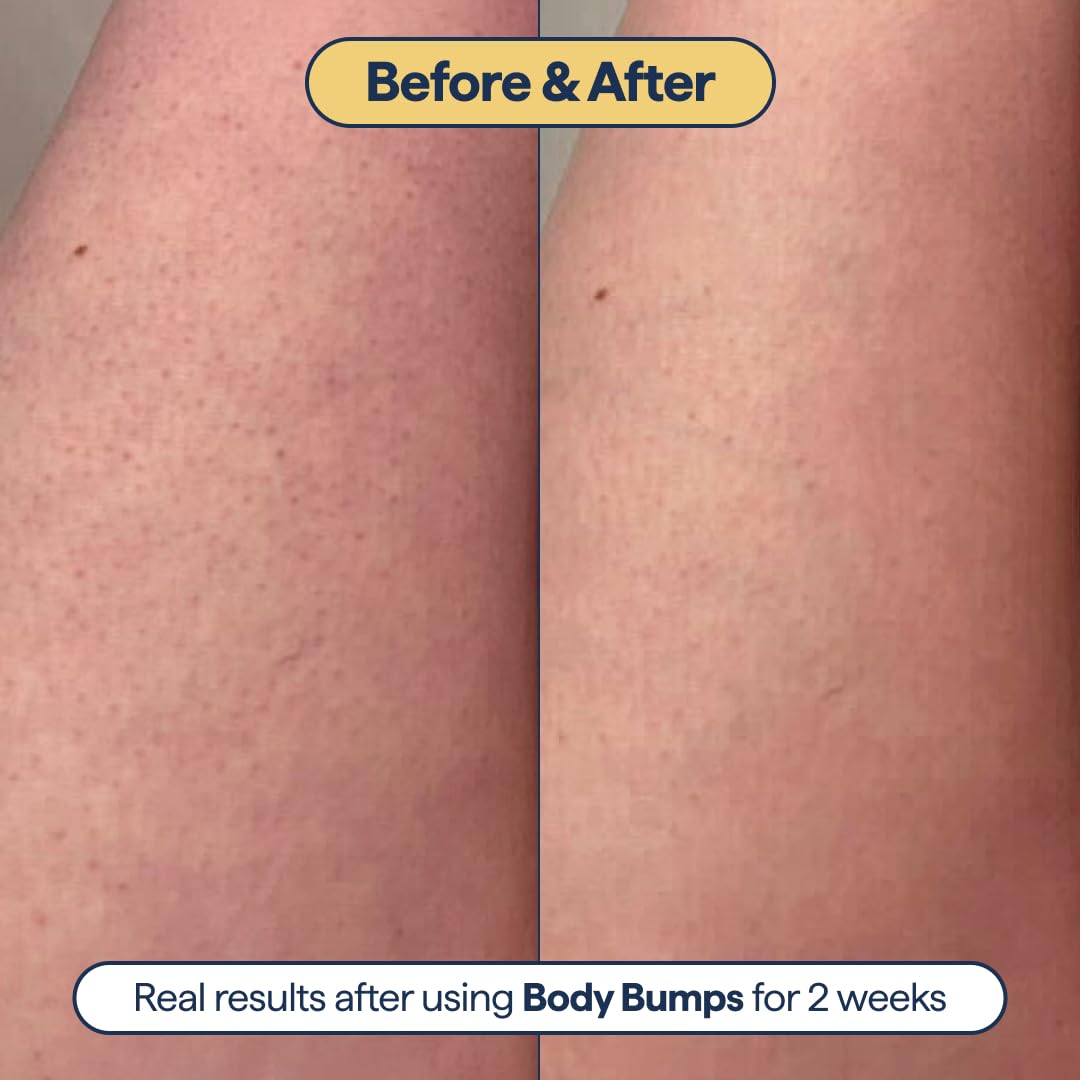 Remedy for Body Bumps – Smoothing Lotion with Urea & Retinol