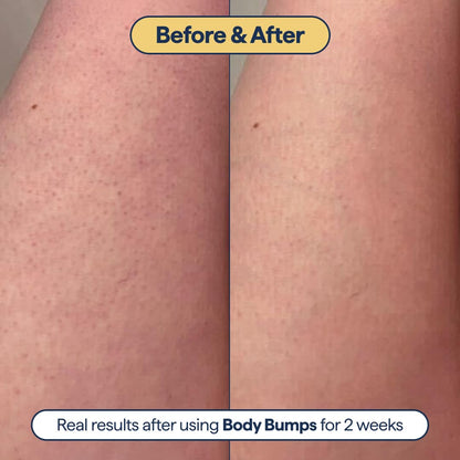 Remedy for Body Bumps – Smoothing Lotion with Urea & Retinol