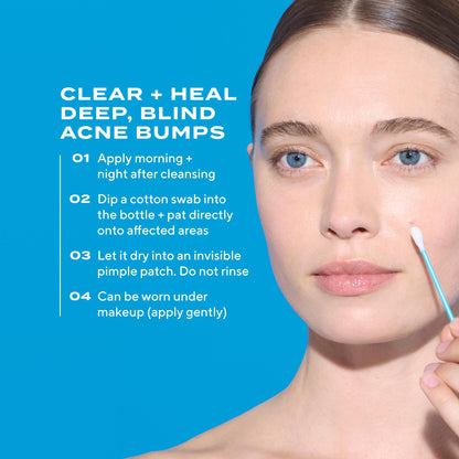 Deep Relief Acne Treatment – Clarifying Facial Formula, 1 oz