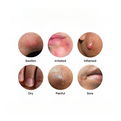 Close-up skin conditions showing swollen, irritated, inflamed, dry, painful, and sore areas commonly treated with Universal Flare Care