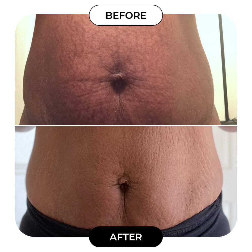 B-FLAT Belly Firming Cream - Tightening & Smoothing Formula for a Toned Look