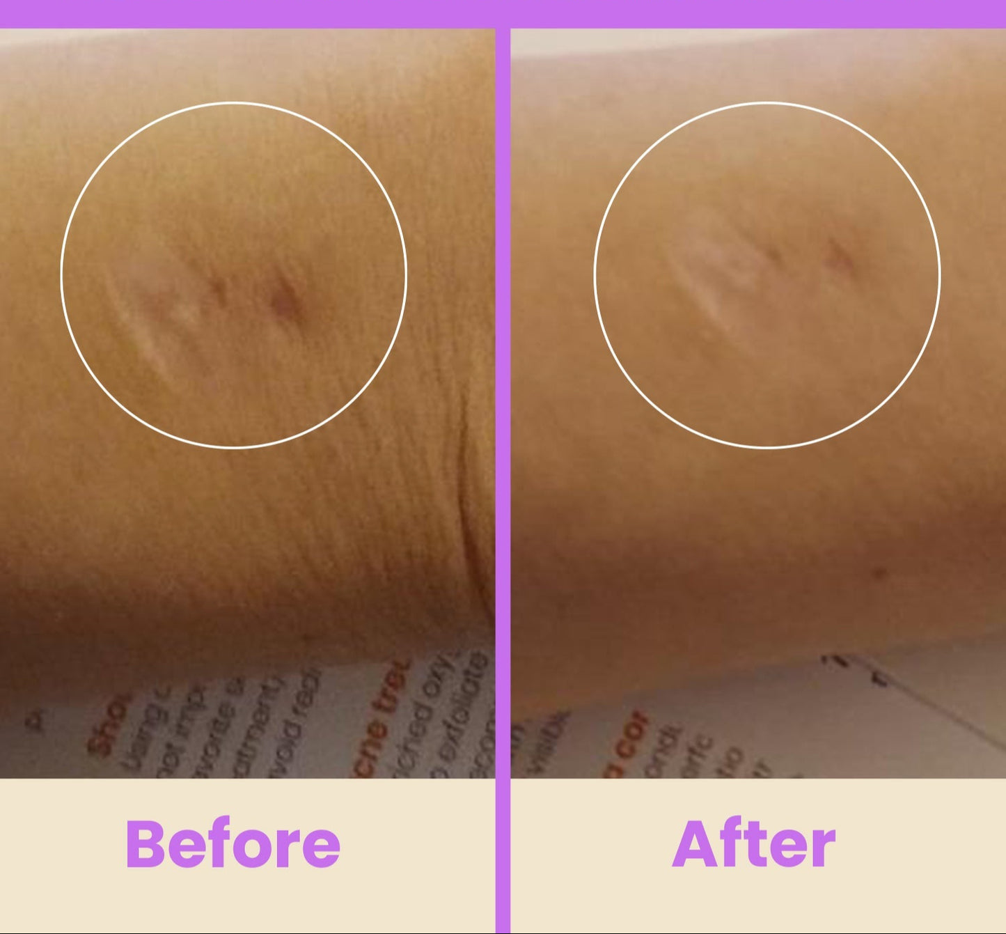 NuDerma Professional High Frequency Wand – Facial Skincare Tool