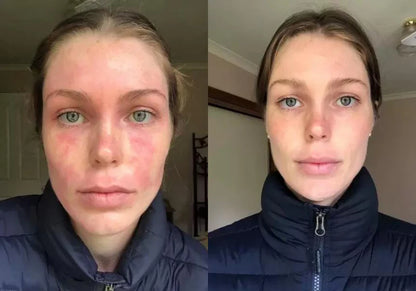 Healed My Eczema - Soothing Cream for Calming & Restoring Irritated Skin