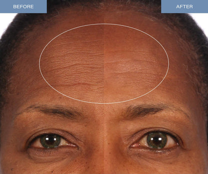 Microdermabrasion Treatment - V5 Crystal Facial Exfoliant Tube