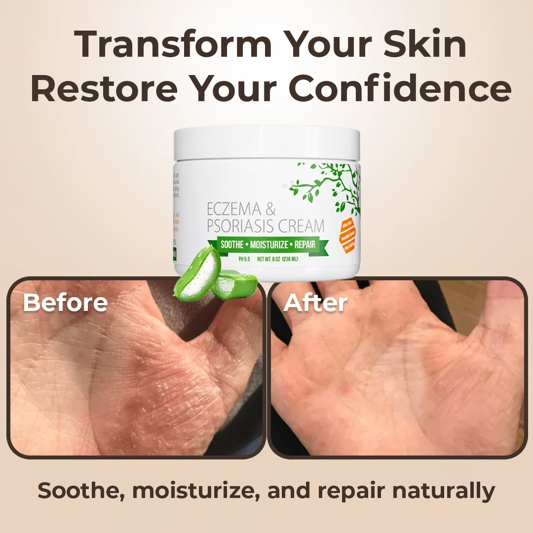 Eczema & Psoriasis Cream – Soothing Moisturizer for Dry Skin
