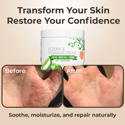 Eczema & Psoriasis Cream – Soothing Moisturizer for Dry Skin
