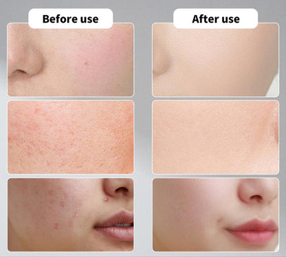 Jungshea Glycolic Acid Pads – Exfoliate Acne, Pores & Dark Spots