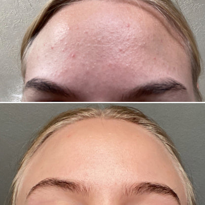 Mandelic Serum 5% – Gentle Exfoliating Serum for Clear, Smooth Skin