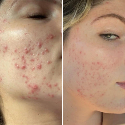 Mandelic Serum 5% – Gentle Exfoliating Serum for Clear, Smooth Skin
