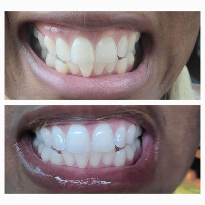 Dissolving Teeth Whitening Strips with Hydroxyapatite - Easy, Enamel-Safe Whitening Solution